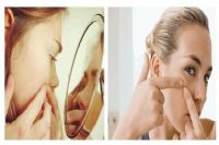 夏季遭遇难缠粉刺？莫慌，小编献妙计