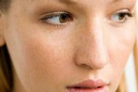 脸上有日晒斑怎么办？教你三个祛斑方法