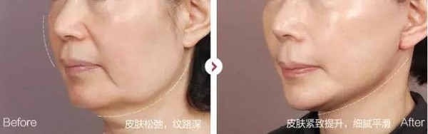 香蕉视频网页版超声刀，业绩翻倍杀手锏