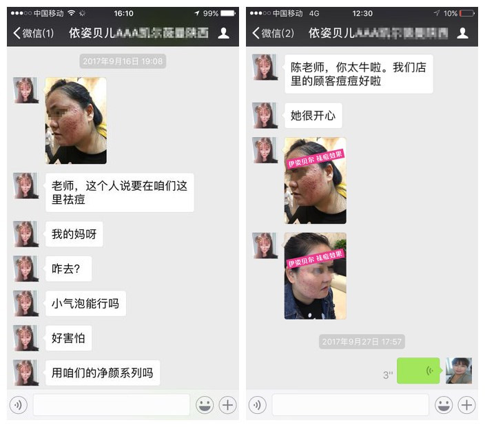 伊姿贝尔祛痘真实案例：爆痘妹重获美丽自信