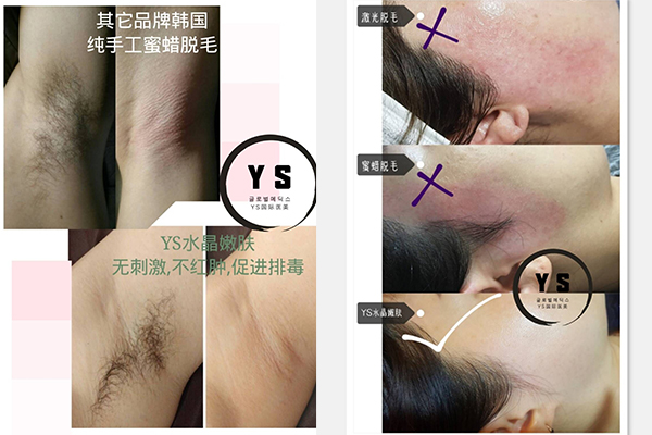 美容院脱毛